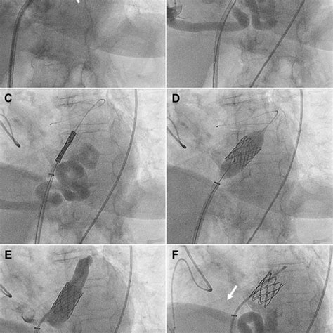 Procedural Angiography | Download Scientific Diagram