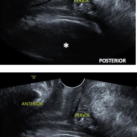 Transvaginal Ultrasound Image 1 The Black Curve An Elongated Cervix