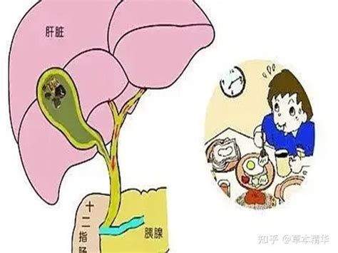 【成都普济中医肿瘤医院杨成平】胰腺瘤晚期患者，治疗侧重点是什么？ 知乎