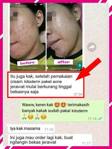 Cream Kitoderm Aman Atau Tidak Homecare24