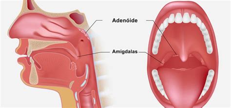 Adenoides E Amigdalas - Cirurgia das amígdalas e adenoides: quando operar