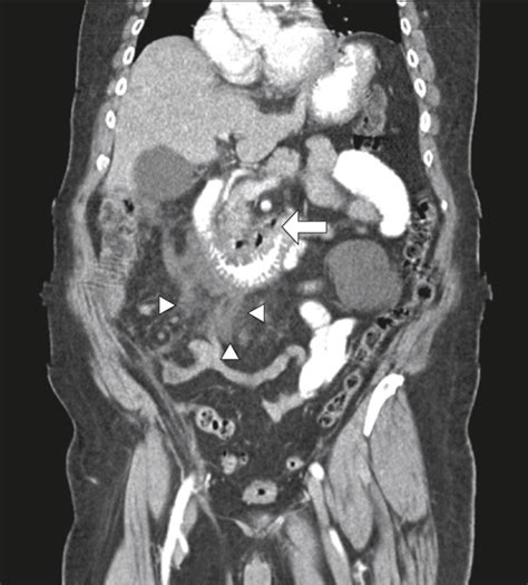 The Perforated Duodenal Diverticulum Gastroenterology Jama Surgery