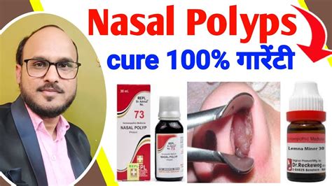 Nasal Polyps Causes Symptoms Homeopathic Medicine How To Cure