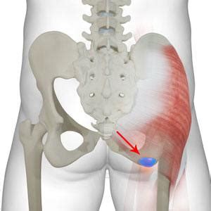 Ischial Bursitis Treatment Atlanta GA Hip Bursitis Marietta Buckhead