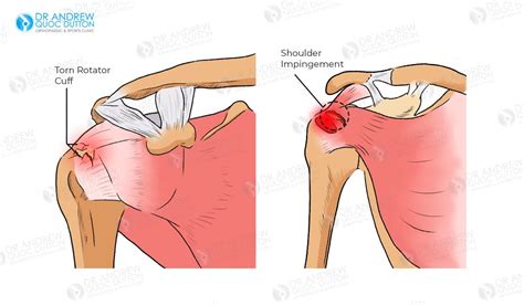 Rotator Cuff Tendonitis