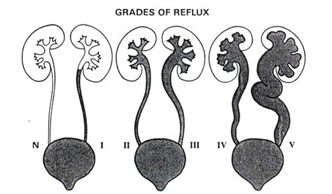 Classification Of Grades Of Vesicoureteral Reflux Adopted By The