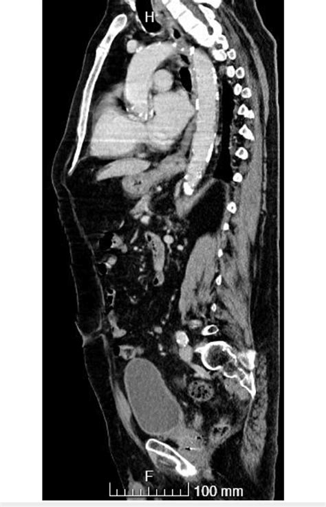 Thoracoabdominal Pelvic Ct Calcified Atheromatosis Of The Entire Aorta