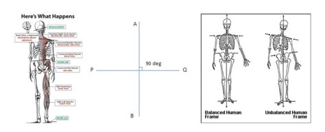 Can Nucca Upper Cervical Chiropractic Help My Bulging Or Herniated Discs Koru Chiropractic