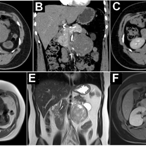 Pdf Schwannoma Celular Retroperitoneal Retroperitoneal Cellular