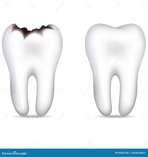 A Caries And Healthy Teeth Before And After Visiting An Orthodontist Or