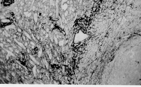 Figure 2 From Pathology Of The Spleen In Hepatosplenic Schistosomiasis