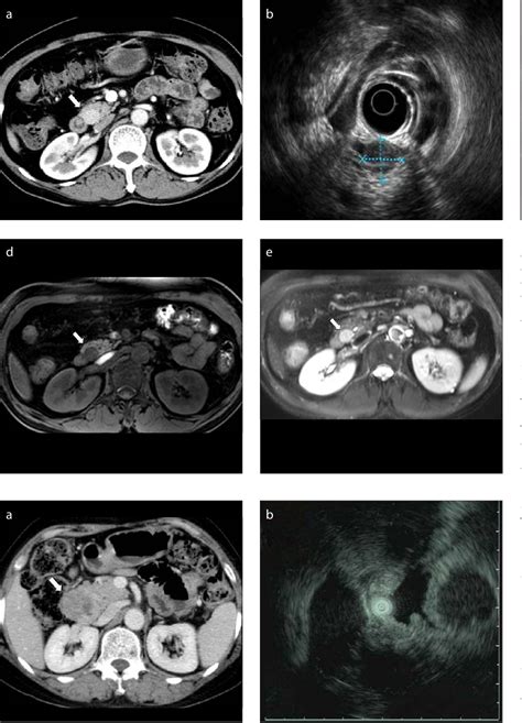 Figure 1 From A Pictorial Review On Clinicopathologic And Radiologic Features Of Duodenal