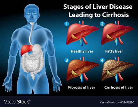 Stages liver disease Royalty Free Vector Image