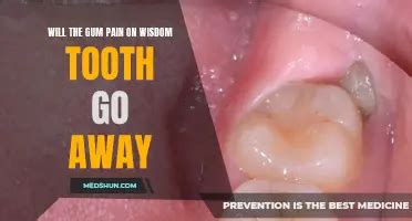 Understanding The Timing Of Wisdom Tooth Growth When Does It Happen