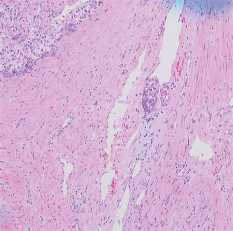 Hepatocellular Carcinoma Staging Differences Between Radiologic And Pathologic Systems And