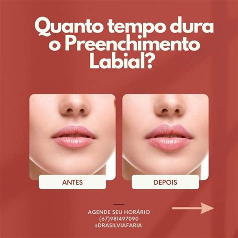 Quanto Tempo Dura O Preenchimento Labial Souriso Dra Silvia Faria