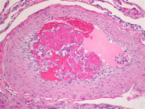 Pulmonary Thromboembolus Organizing A Photo On Flickriver