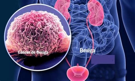 C Ncer De Bexiga Causas Sintomas E Tratamentos Dicas De Sa De