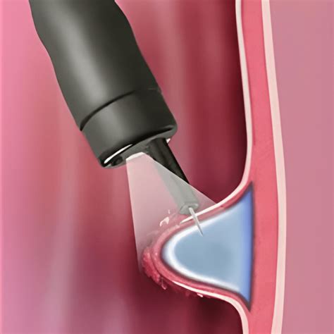 Endoscopic Submucosal Dissection Esd Gastrosameer