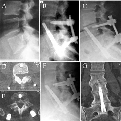 Results and complications after 2-level axial lumbar interbody fusion with a minimum 2-year ...