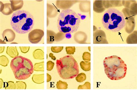 Representative Peripheral Blood Smears From Patients With MYH9