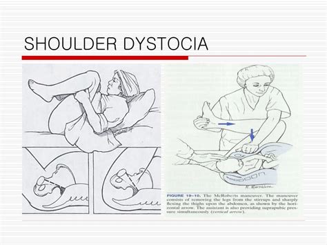 Mcroberts Maneuver Shoulder Dystocia