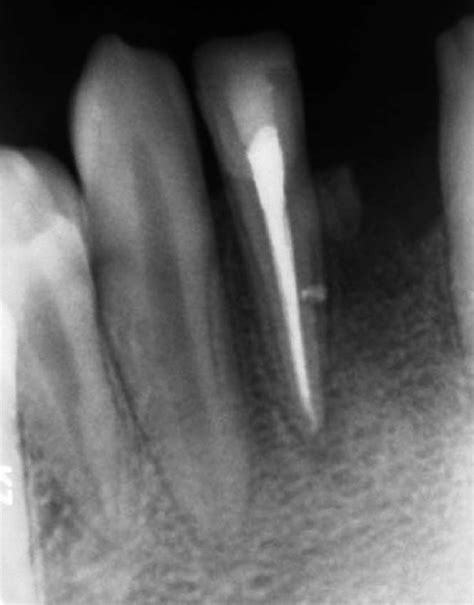 Periapical Radiograph Of The Upper Central Incisors After Treatment