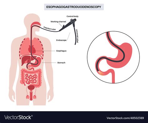 Esophagogastroduodenoscopy medical procedure Vector Image