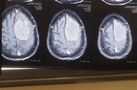 Meningioma: Causes, Symptoms and Treatment