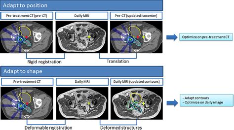 Adaptive Radiotherapy The Elekta Unity Mr Linac Concept Clinical And Translational Radiation