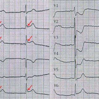 The ECG Of A 55 Year Old Man Presenting With Chest Pain For