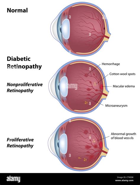 Diabetic Retinopathy Hi Res Stock Photography And Images Alamy