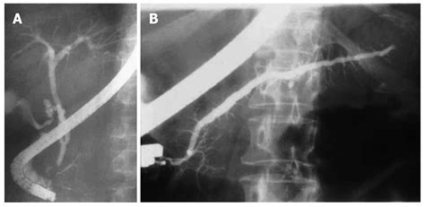 Role Of Endoscopic Retrograde Cholangiopancreatography In Acute Pancreatitis