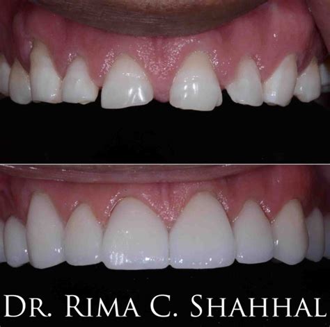 Crowns vs. Veneers | 5 Reasons to Place a Dental Crown on Front Teeth