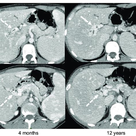 Example Of Acute Portal Vein Thrombosis With Progressive Development Of