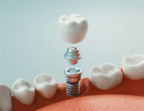 Things You Didn T Know About Dental Implants Cadillac Mi