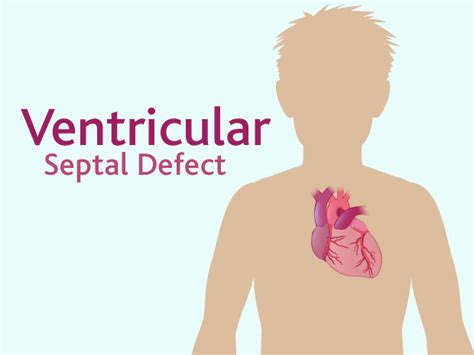 Pathophysiology Of Ventricular Septal Defect In Flow Chart A Visual Reference Of Charts Chart