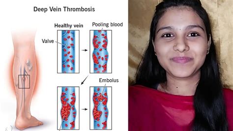 Dvt Deep Vein Thrombosis Special Drugs Cause And Effects Youtube