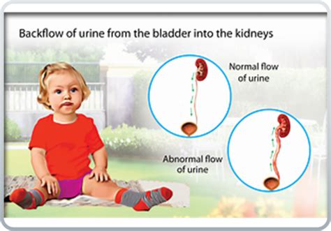 S P Final Urology Flashcards Quizlet