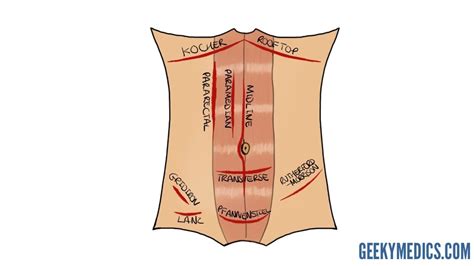 Pelvic Surgery Incisions