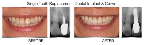 Esthetic Dental Implants - Anterior Teeth Philadelphia | Esthetic Tooth ...