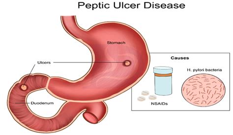 Helicobacter pylori Bacteria - Digestive and Liver Health Specialists