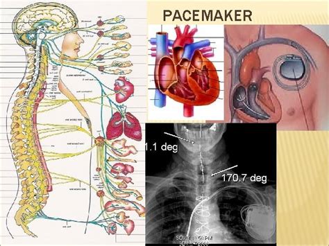 Heart Disease Prevention Reversal Men Are Not Prisoners