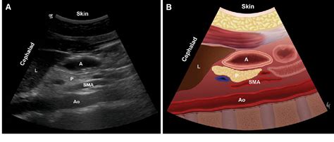 Gastric residual volume - junctionrety