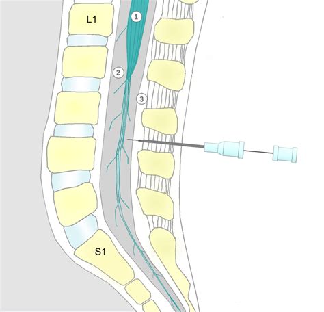 Difference Between Spinal and Epidural Anesthesia | Purpose, Procedure ...