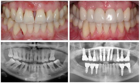 Symptoms Of Bone Loss In Teeth - Teeth Poster