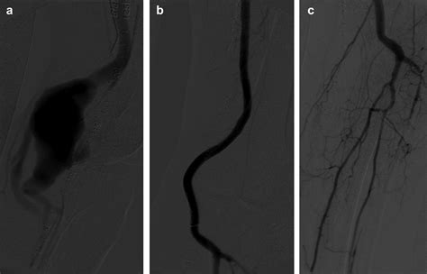 Endovascular Repair Of A Ruptured Popliteal Artery Aneurysm Associated