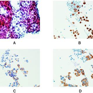 Fine Needle Aspiration Of The Thyroid Mass Papanicolaou Staining