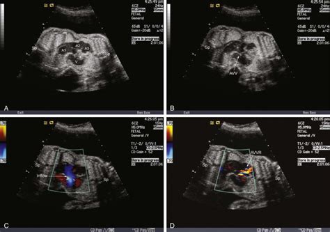 Conjoined Twins | Radiology Key