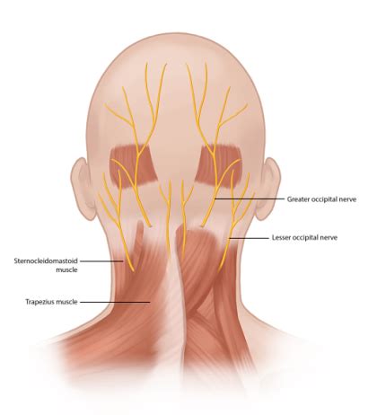 Occipital Neuralgia Treatment | Headache Pain Relief | Pain Spa ...